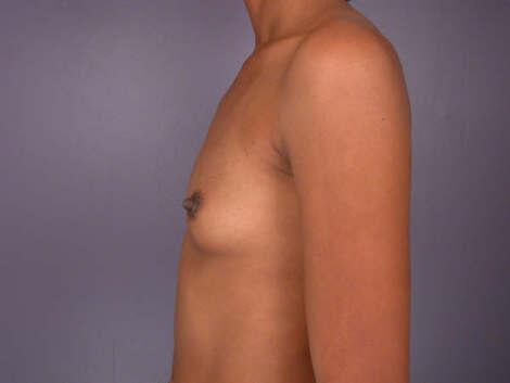 Breast Augmentation Before & After Image