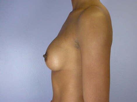 Breast Augmentation Before & After Image