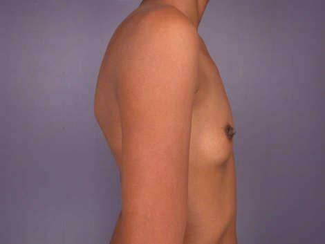 Breast Augmentation Before & After Image