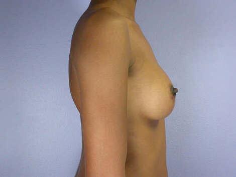 Breast Augmentation Before & After Image