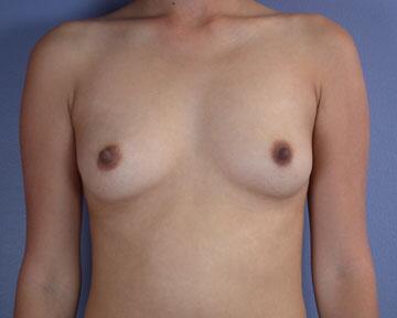 Breast Augmentation Before & After Image