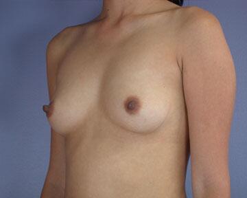 Breast Augmentation Before & After Image