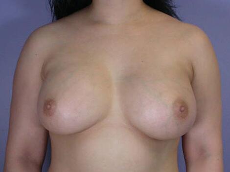 Breast Augmentation Before & After Image