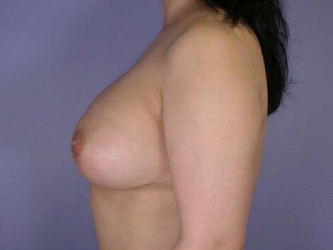 Breast Augmentation Before & After Image