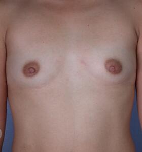 Breast Augmentation Before & After Image