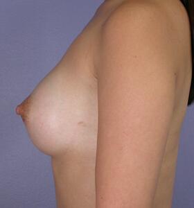 Breast Augmentation Before & After Image