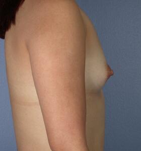 Breast Augmentation Before & After Image