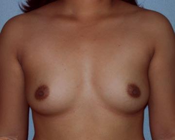 Breast Augmentation Before & After Image