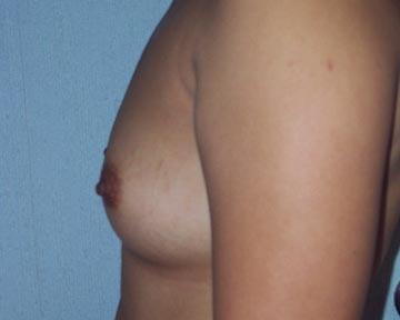 Breast Augmentation Before & After Image