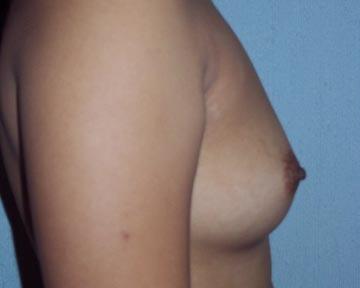 Breast Augmentation Before & After Image