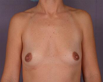 Breast Augmentation Before & After Image