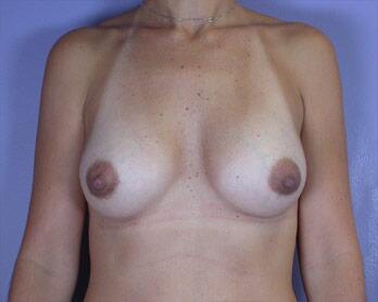 Breast Augmentation Before & After Image