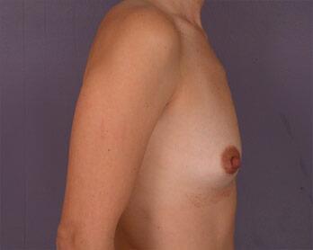 Breast Augmentation Before & After Image