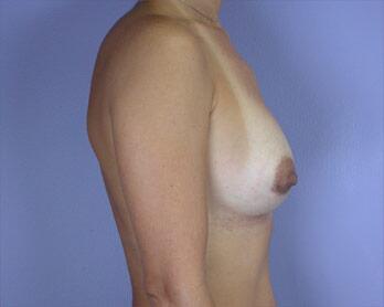 Breast Augmentation Before & After Image