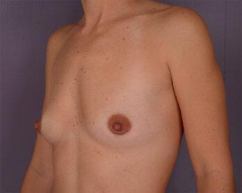 Breast Augmentation Before & After Image