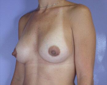 Breast Augmentation Before & After Image