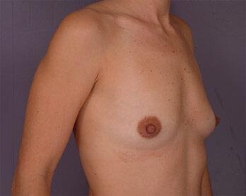 Breast Augmentation Before & After Image