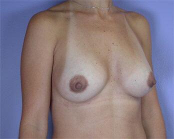 Breast Augmentation Before & After Image