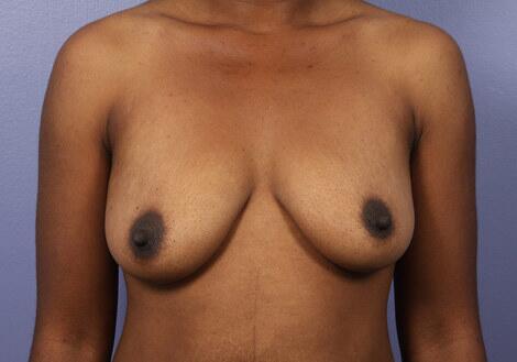 Breast Augmentation Before & After Image