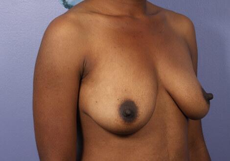 Breast Augmentation Before & After Image