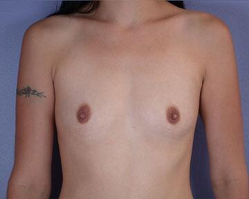 Breast Augmentation Before & After Image