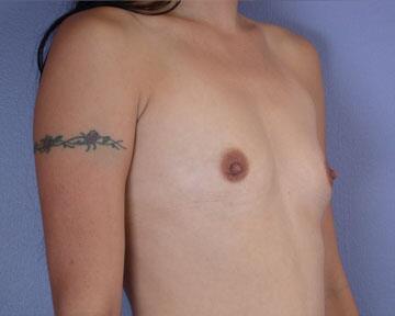 Breast Augmentation Before & After Image