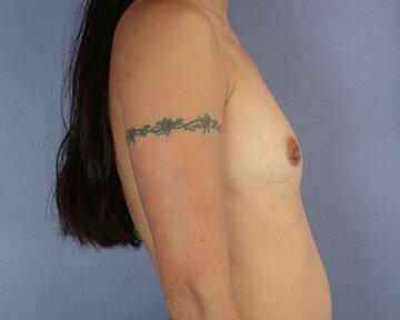 Breast Augmentation Before & After Image