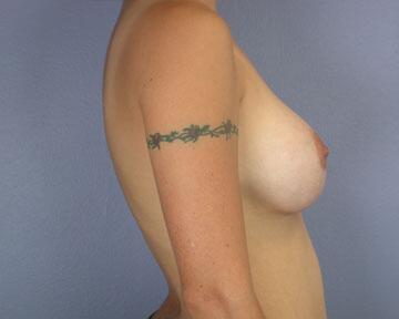 Breast Augmentation Before & After Image