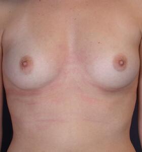 Breast Augmentation Before & After Image