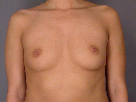 Breast Augmentation Before & After Image