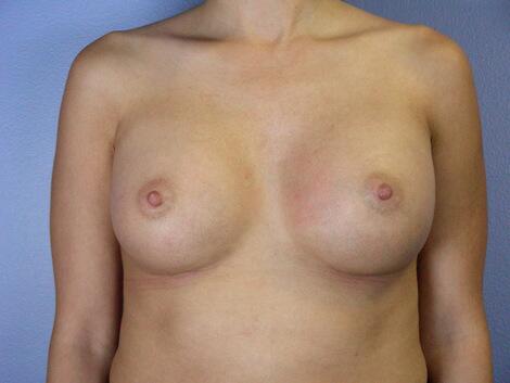 Breast Augmentation Before & After Image