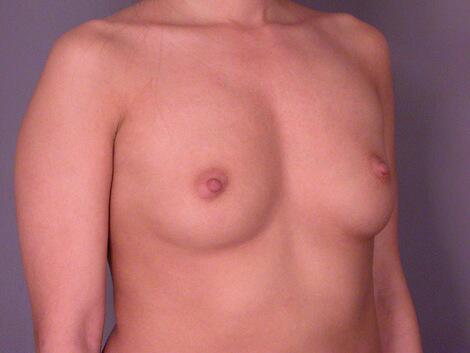 Breast Augmentation Before & After Image