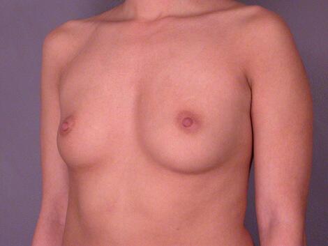 Breast Augmentation Before & After Image