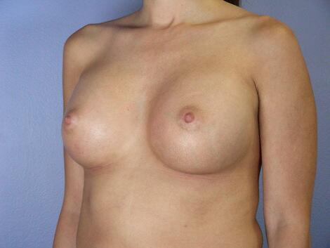 Breast Augmentation Before & After Image