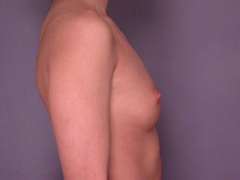 Breast Augmentation Before & After Image