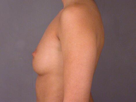 Breast Augmentation Before & After Image