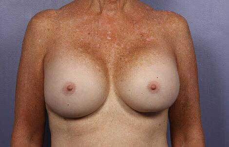 Breast Augmentation Before & After Image