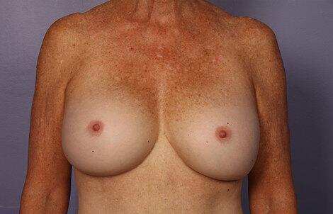 Breast Augmentation Before & After Image