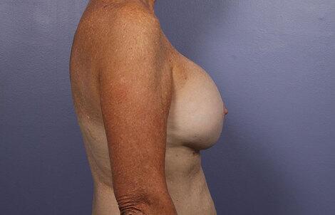 Breast Augmentation Before & After Image