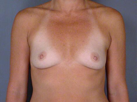 Breast Augmentation Before & After Image