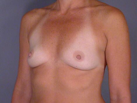 Breast Augmentation Before & After Image