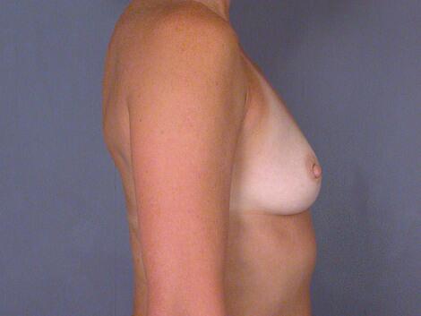 Breast Augmentation Before & After Image