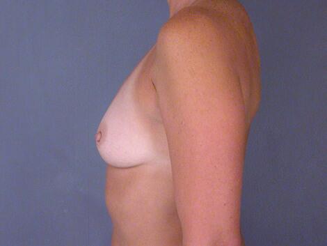 Breast Augmentation Before & After Image