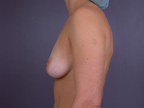 Breast Augmentation Before & After Image