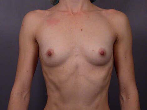 Breast Augmentation Before & After Image