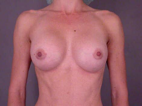 Breast Augmentation Before & After Image