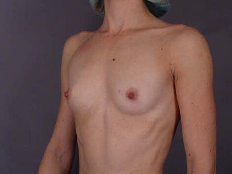 Breast Augmentation Before & After Image