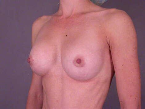 Breast Augmentation Before & After Image