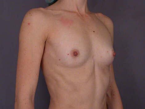 Breast Augmentation Before & After Image