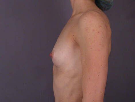 Breast Augmentation Before & After Image